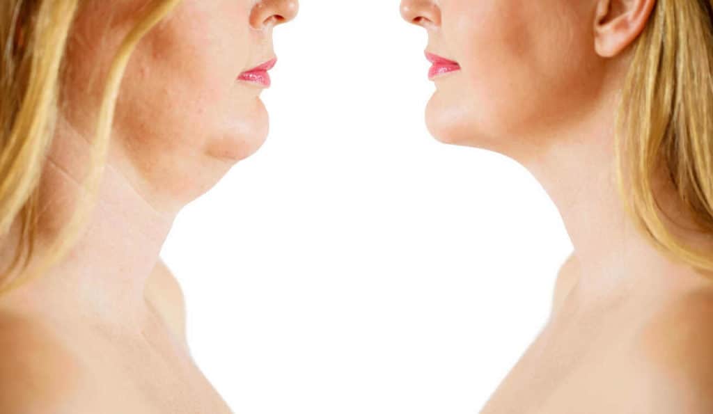 Double Chin treatment Fulwell before and after results