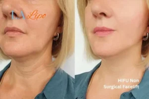 hi-fu for wrinkles Fulwell before and after results