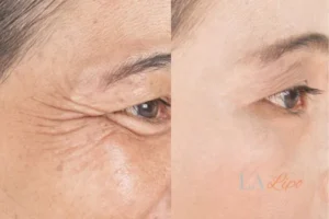 Before and after results of woman - HI-fu wrinkles reduction treatment Fulwell