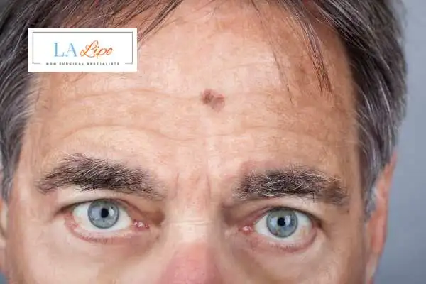Solar Lentigo Removal Fulwell image of man with mark on his forehead