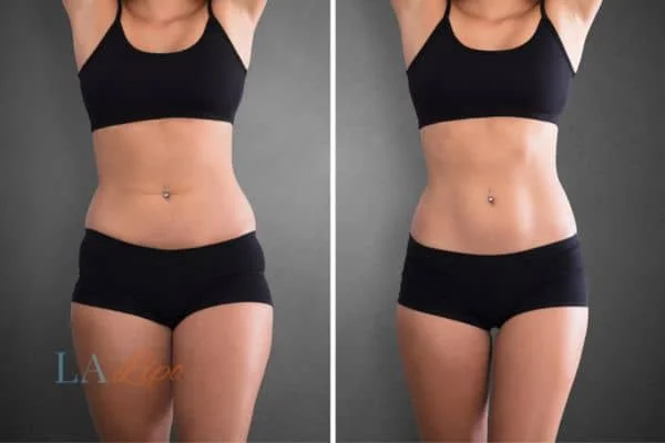 before and after results of non-surgical treatment to help a woman's body image and mental health Fulwell