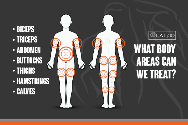 Diagram to show areas you can have LA-EMS Body Sculpting Treatment Fulwell
