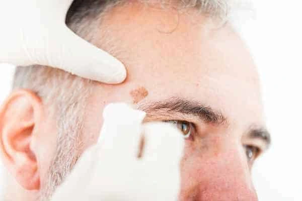 Age spots and elderly people Fulwell what is the link?