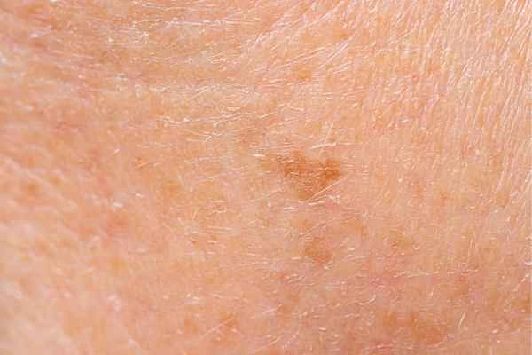 close up picture of age spots Fulwell